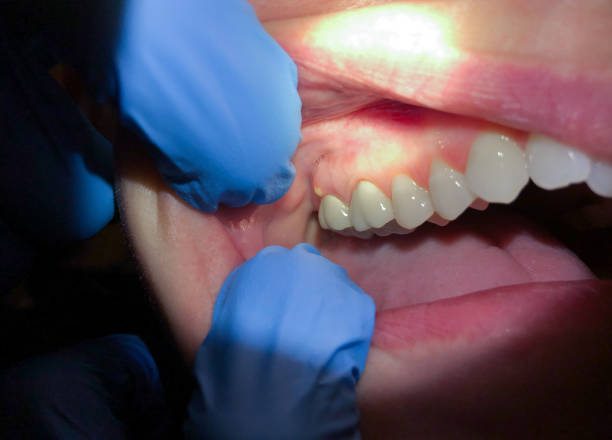 Best Lost Filling or Crown Replacement in Chaska, MN
